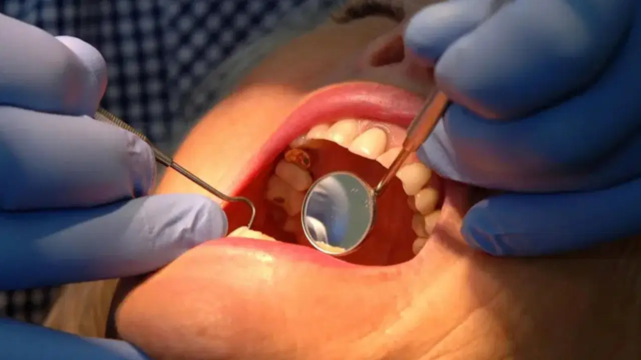 dis minesini onaran yeni jel curuklerin sonu mu geliyor n3VFfYrL.jpg